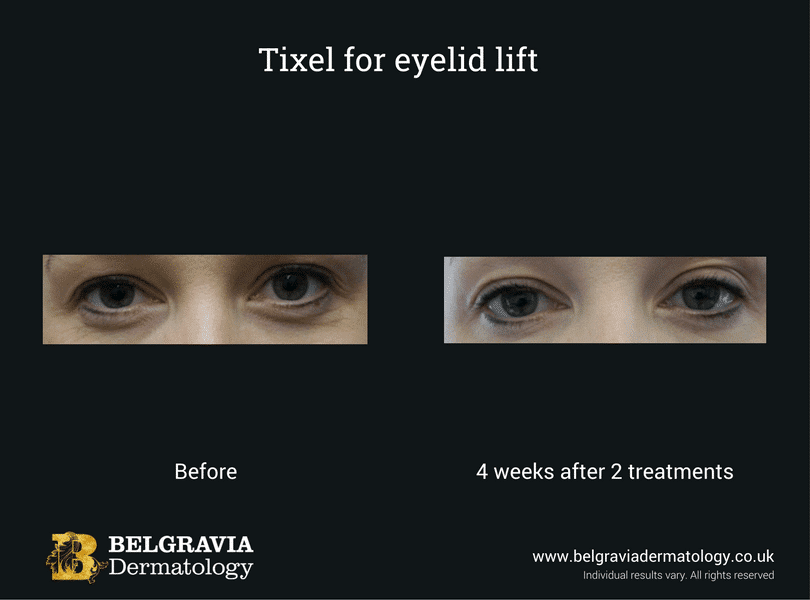 Tixel-for-eyelid-lift-2