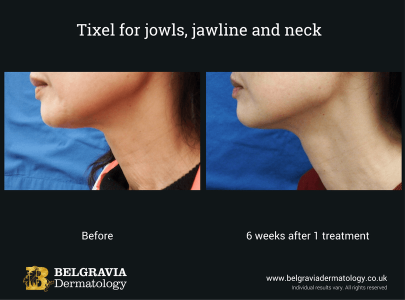 Tixel-for-jowls-jawline-and-neck