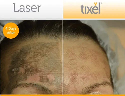 tixel-compared-to-fractional-CO2-laser