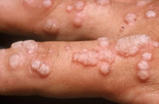 viral-warts