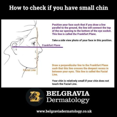 Chin fillers