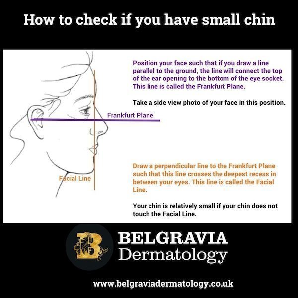 How to check if you have a small chin for chin filler treatment.