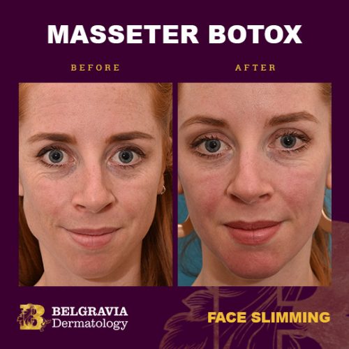 botox-for-masseter-muscles-in-london-for-face-slimming-and-teeth-grinding