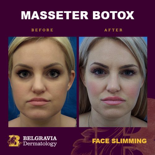 Botox For Masseter Muscles In London For Face Slimming And Teeth Grinding   Botox Masseter Face Slimming Belgravia Dermatology 500x500 