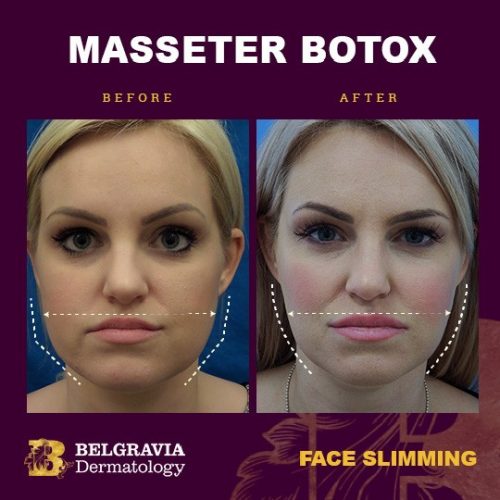 Botox Masseter Showing Jaw Reduction 500x500 