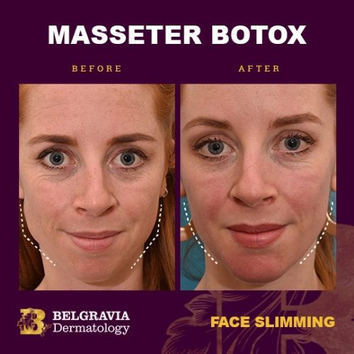 Botox for masseter muscles in London for face slimming and teeth grinding