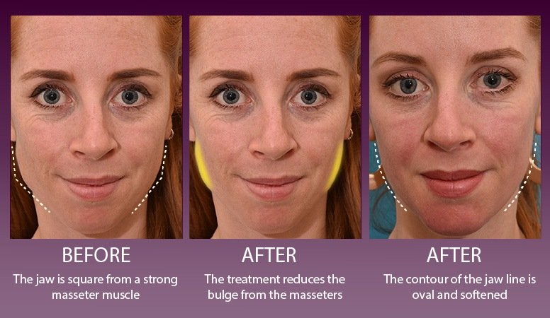 Botox Masseter Muscles To Slim Face And Improve Teeth Grinding – Charmed  Medispa