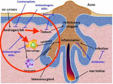 mild cystic acne diagram